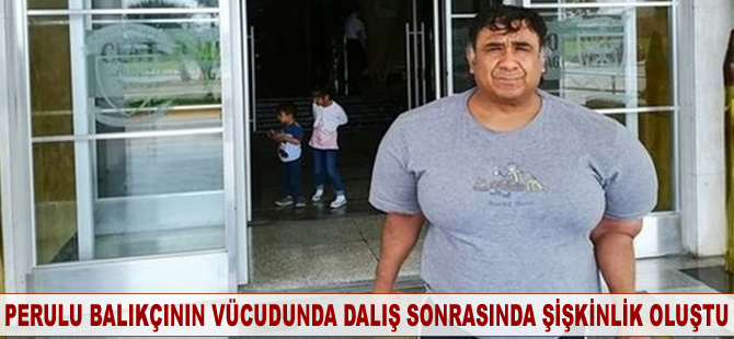 Perulu balıkçının vücudunda dalış sonrasında şişkinlik oluştu