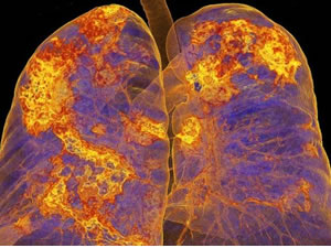 Koronavirüs vücudu nasıl etkiliyor?