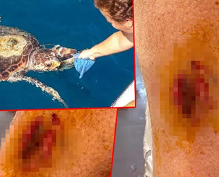 Caretta caretta, denize giren kadının bacağından ısırdı
