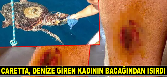 Caretta caretta, denize giren kadının bacağından ısırdı