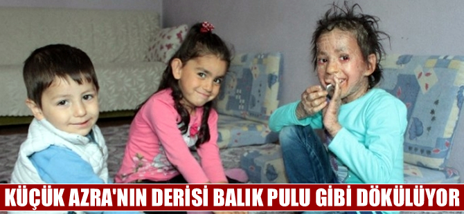 Azra'nın derisi balık pulu gibi dökülüyor