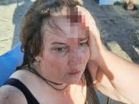 Denizde yüzerken Jet ski çarptı, ölümden döndü