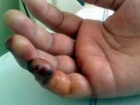 Denizlerin engerek yılanı Trakonya bir kadını hastanelik etti